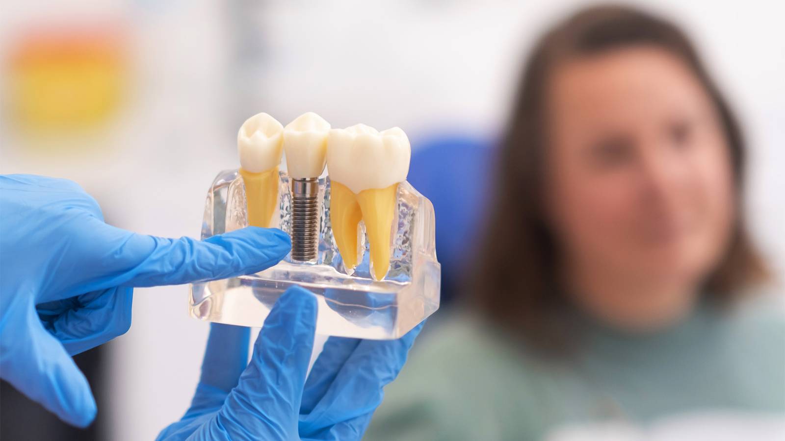 All on 6 with fixed porcelain denture – per jaw