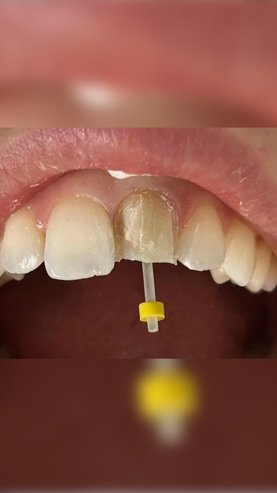 Dental Bonding vs Composite & Edge Bonding Guide